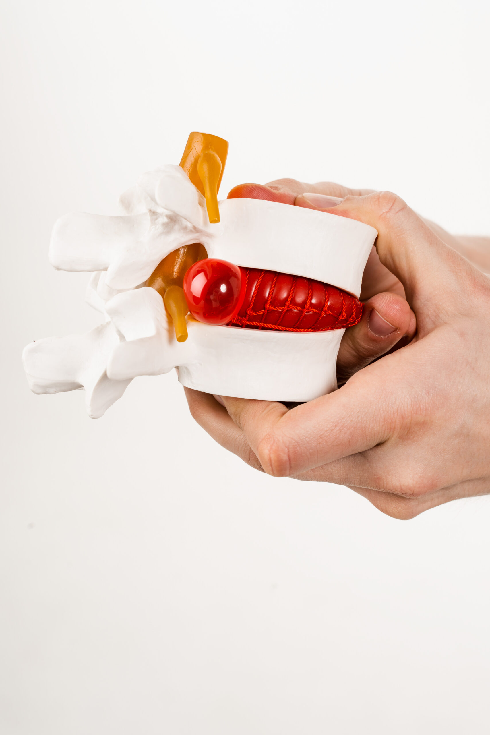 spinal-disc-model-demonstrates-bulging-with-human
